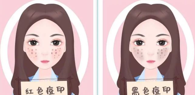 臉上紅色痘印幾個(gè)月都不消怎么辦？紅色痘印應(yīng)該怎么消除？