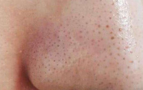 清潔面膜哪個牌子可以快速祛黑頭？趙薇、薇婭 推薦的紐西之謎泥膜真的好用嗎？